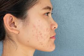 papules acne