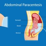 Paracentesis Understanding the Procedure and Its Benefits paracentesis