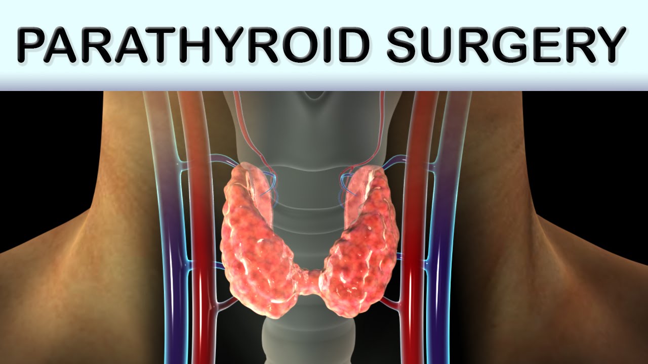 parathyroidectomy