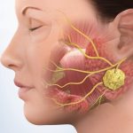 Decoding Parotid Gland Swelling: Causes and Solutions parotid gland swelling