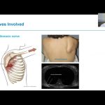 The Mysteries of Parsonage Turner Syndrome A Comprehensive Guide parsonage turner syndrome