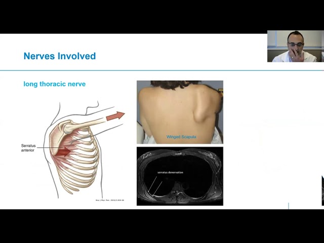 parsonage turner syndrome