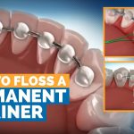 The Benefits and Care of a Permanent Retainer permanent retainer
