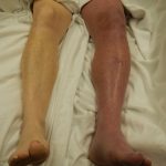 Phlegmasia Cerulea Dolens Causes, Symptoms, and Treatment phlegmasia cerulea dolens