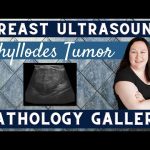 Phyllodes Tumor Symptoms, Diagnosis, and Treatment phyllodes tumor