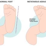 Pigeon Toed Causes, Treatments, and Prevention Tips pigeon toed