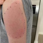 Pneumonia Vaccine Side Effects What You Need to Know pneumonia vaccine side effects