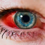 Popped Blood Vessel Causes, Symptoms, and Treatment popped blood vessel