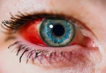 Popped Blood Vessel Causes, Symptoms, and Treatment popped blood vessel