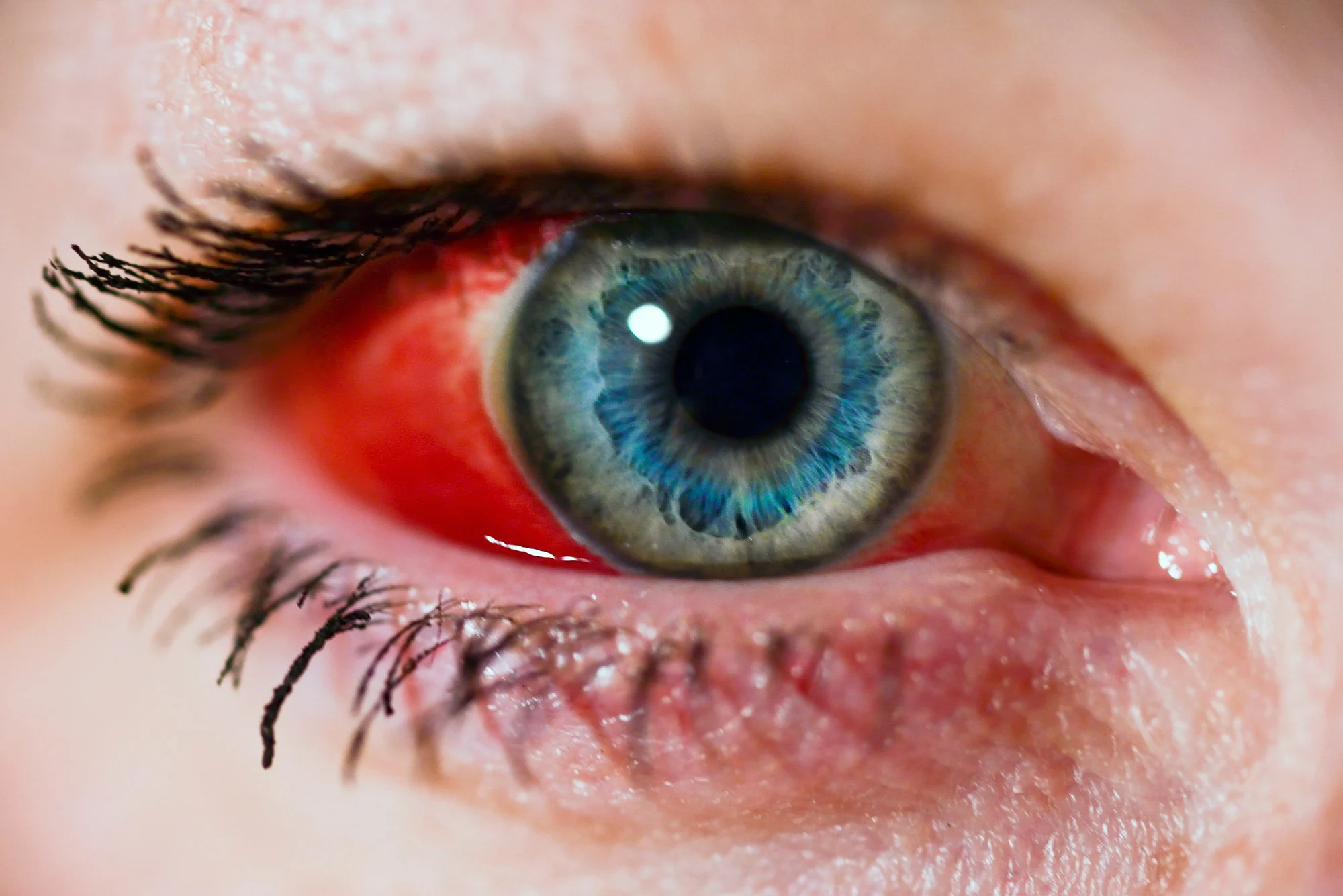 Popped Blood Vessel Causes Symptoms And Treatment