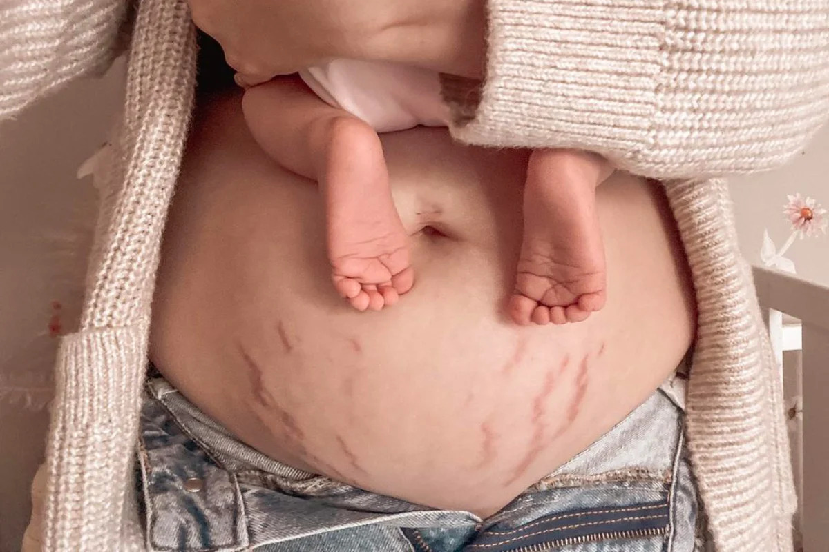 pregnancy stretch marks