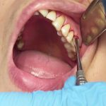 The Art of Pulling Teeth A Comprehensive Guide to Dental Extraction pulling teeth