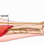 Demystifying Radial Tunnel Syndrome: Causes, Symptoms, and Treatment radial tunnel syndrome