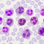 The Enigma: Rare Polymorphonuclear Leukocytes Explained rare polymorphonuclear leukocytes