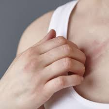 rash on breast