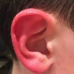 Decoding Red Ear Syndrome: Causes, Symptoms, and Solutions red ear syndrome