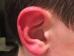 red ear syndrome