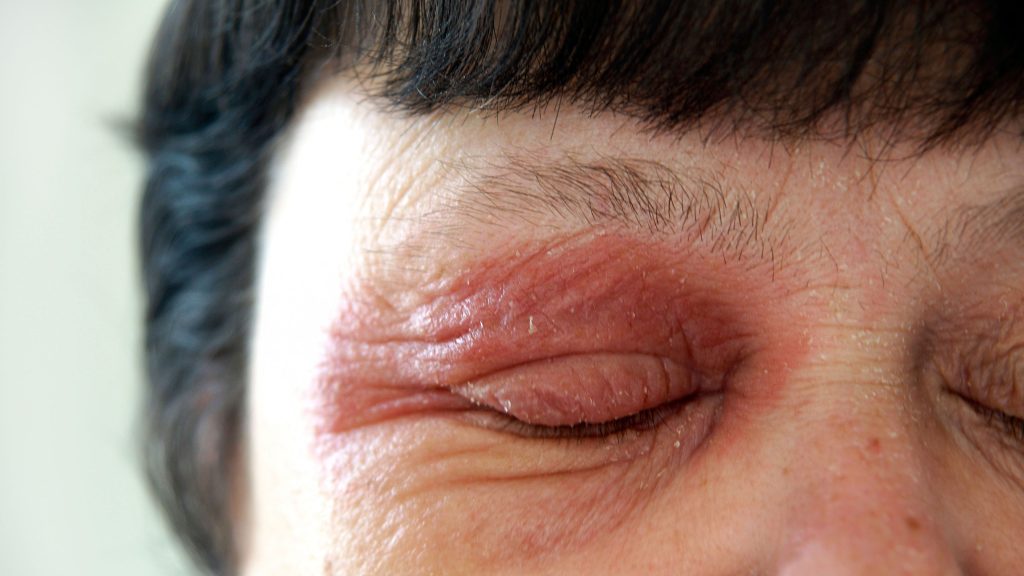 eyelid-redness-causes-symptoms-inflamed-dry-itchy-swollen-red