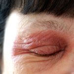 Managing Redness Around Eyes Causes and Solutions redness around eyes