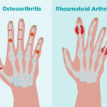 Differences Between Rheumatoid Arthritis vs Osteoarthritis: Know the Contrast rheumatoid arthritis vs osteoarthritis