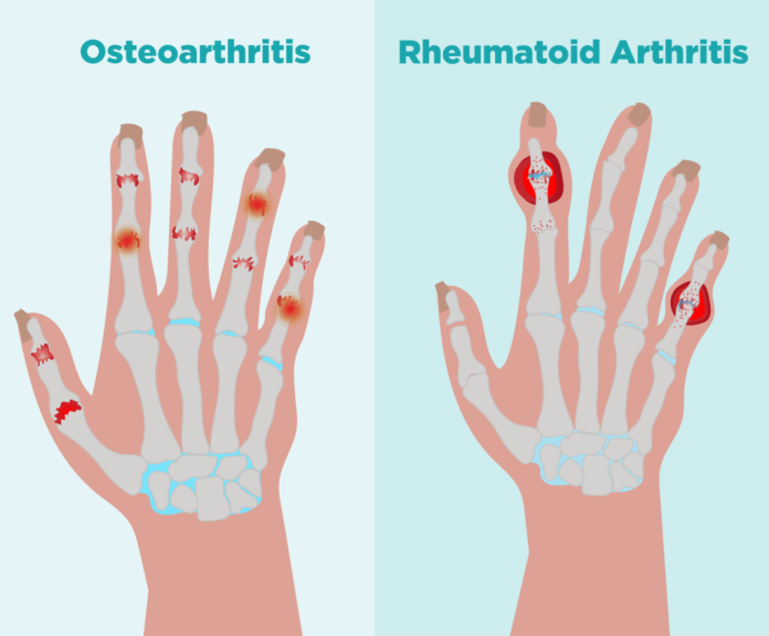 Differences Between Rheumatoid Arthritis vs Osteoarthritis