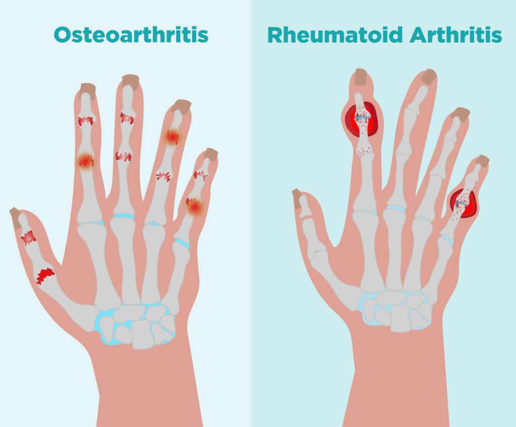 rheumatoid arthritis vs osteoarthritis