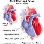 Right Sided Heart Failure Causes, Symptoms, and Treatment right sided heart failure