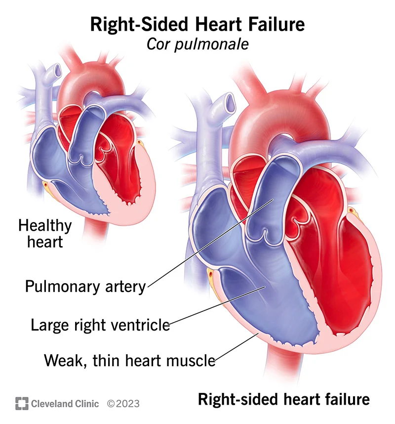 right sided heart failure