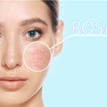 Navigating Rosacea Medication: Treatment Options and Tips rosacea medication