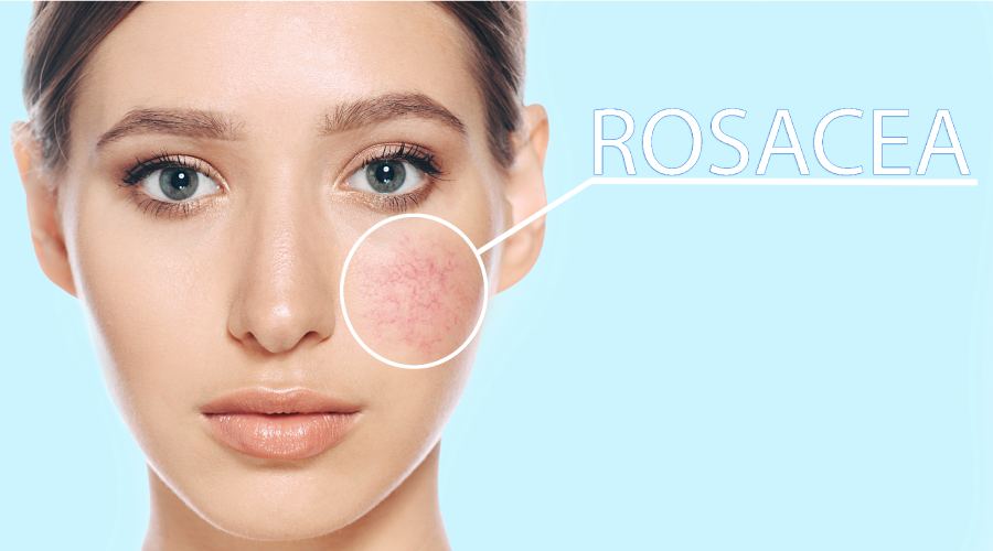 rosacea medication