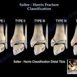 Salter Harris Fractures Types, Symptoms, and Treatment salter harris fracture