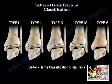 salter harris fracture