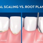 Comprehensive Guide to Scaling and Root Planing Restoring Oral Health scaling and root planing
