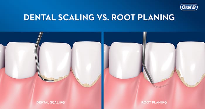 scaling and root planing