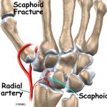 Scaphoid Fractures Causes, Symptoms, and Treatment scaphoid fracture