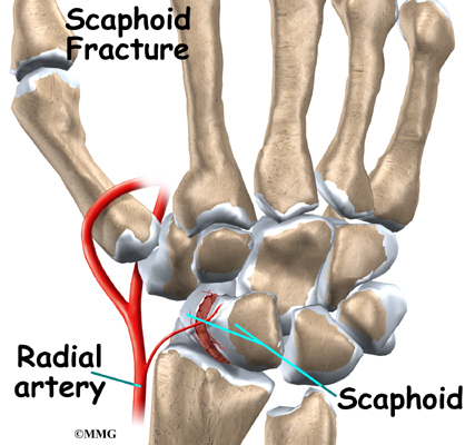 scaphoid fracture