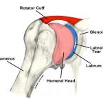 Shoulder Labrum Tears Causes, Symptoms, and Treatment shoulder labrum