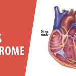 Sick Sinus Syndrome: Causes, Symptoms, and Treatment Options sick sinus syndrome