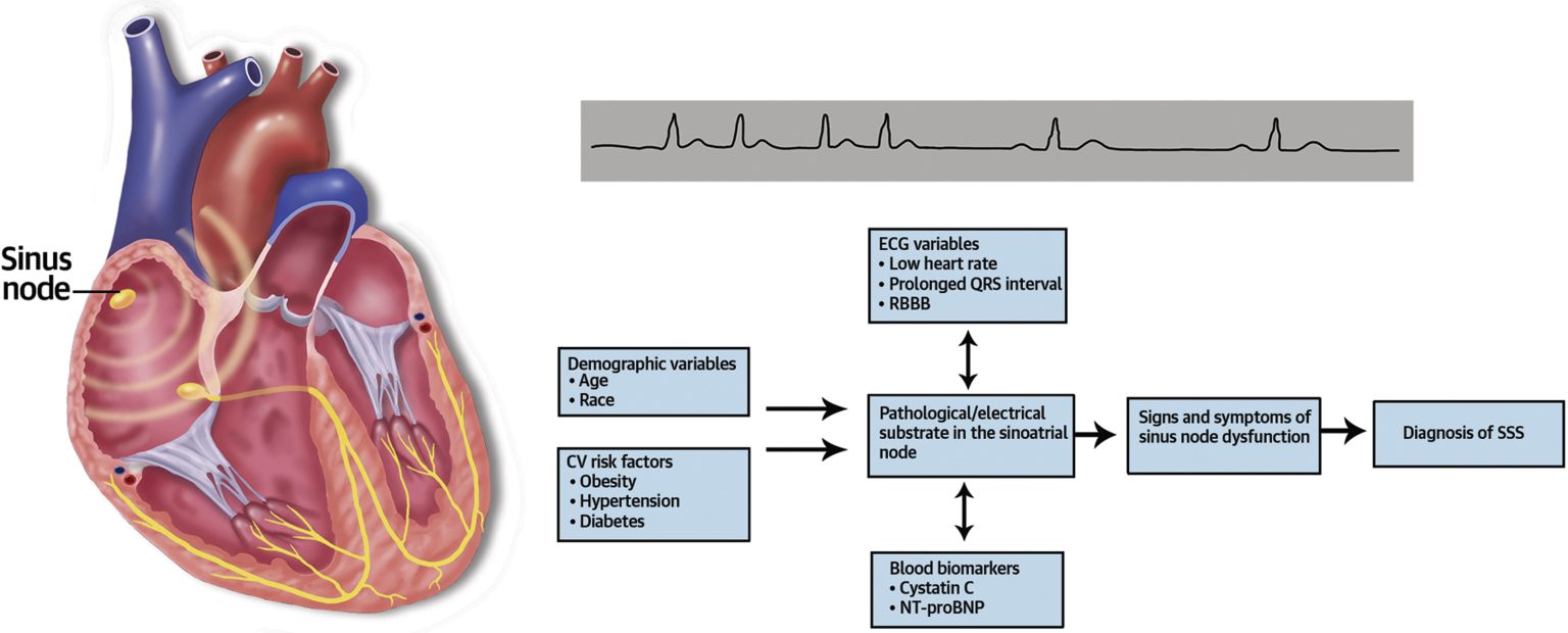 Demystifying Sick Sinus Syndrome