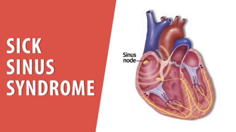 Sick Sinus Syndrome: Causes, Symptoms, and Treatment Options