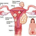 The Signs of Fibroids Breaking Down What You Need to Know signs of fibroids breaking down