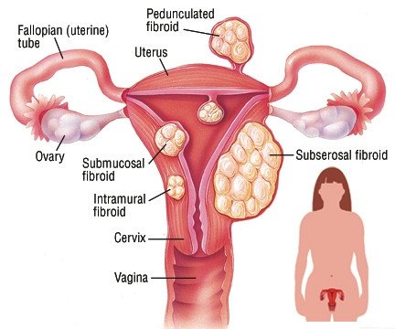 signs of fibroids breaking down