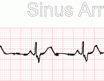 Deciphering Sinus Rhythm with PAC: A Comprehensive Guide sinus rhythm with pac