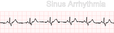 sinus rhythm with pac