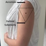 SIRVA: Shoulder Injury Related to Vaccine Administration sirva