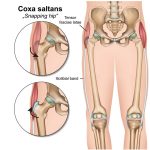 Snapping Hip Syndrome: Causes, Symptoms, and Treatment snapping hip syndrome