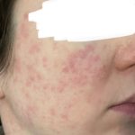 The Benefits of Soolantra Your Guide to Clear Skin soolantra