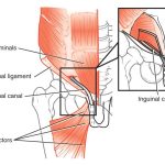 Unmasking the Mystery Sports Hernia Explained sports hernia