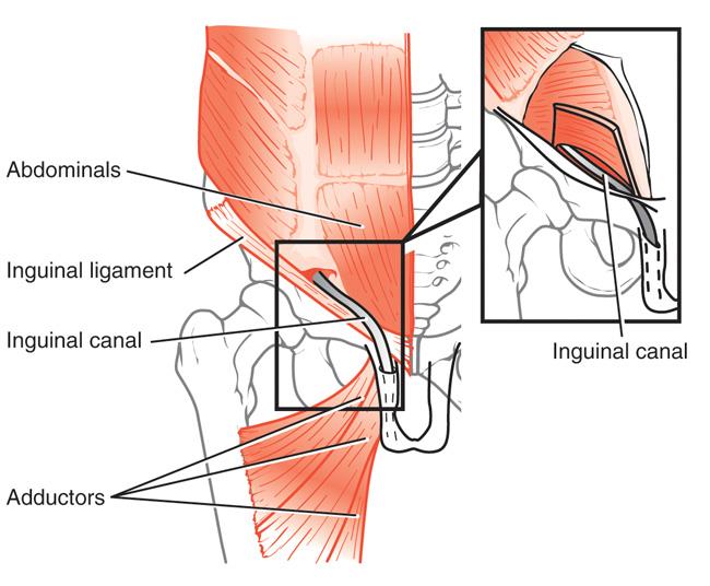 sports hernia