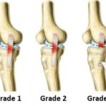 Dealing with a Sprained Knee Causes, Symptoms, and Recovery sprained knee